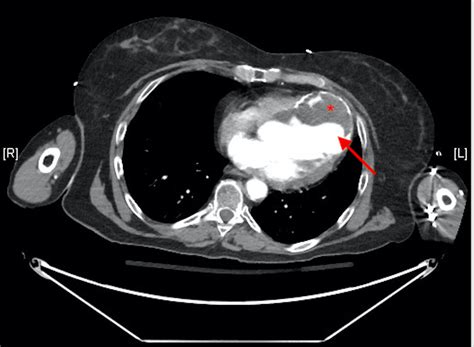 what is an apical aneurysm.